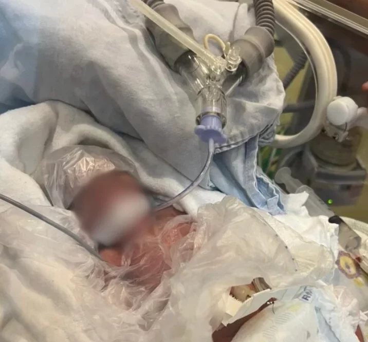 Bebê prematuro de 25 semanas é salvo em parto histórico no Materno Infantil de Cacoal