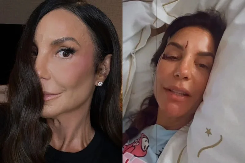 Acidentes domésticos podem acontecer com qualquer pessoa: especialista alerta após caso de Ivete Sangalo